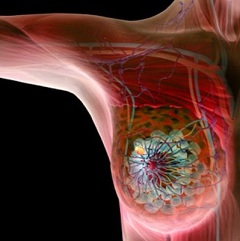 Рак молочной железы наиболее частый вид злокачественной опухоли у женщин